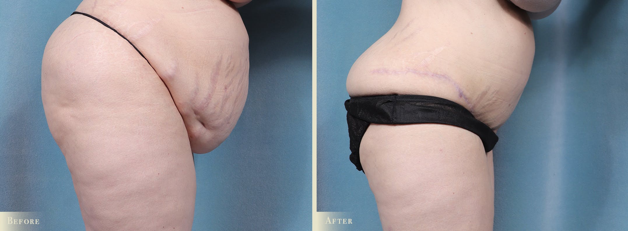 Tummy Tuck Before & After Gallery - Patient 336558 - Image 4
