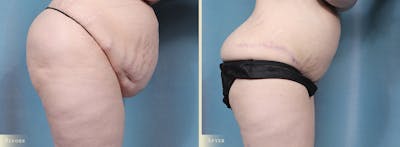 Tummy Tuck Before & After Gallery - Patient 336558 - Image 4