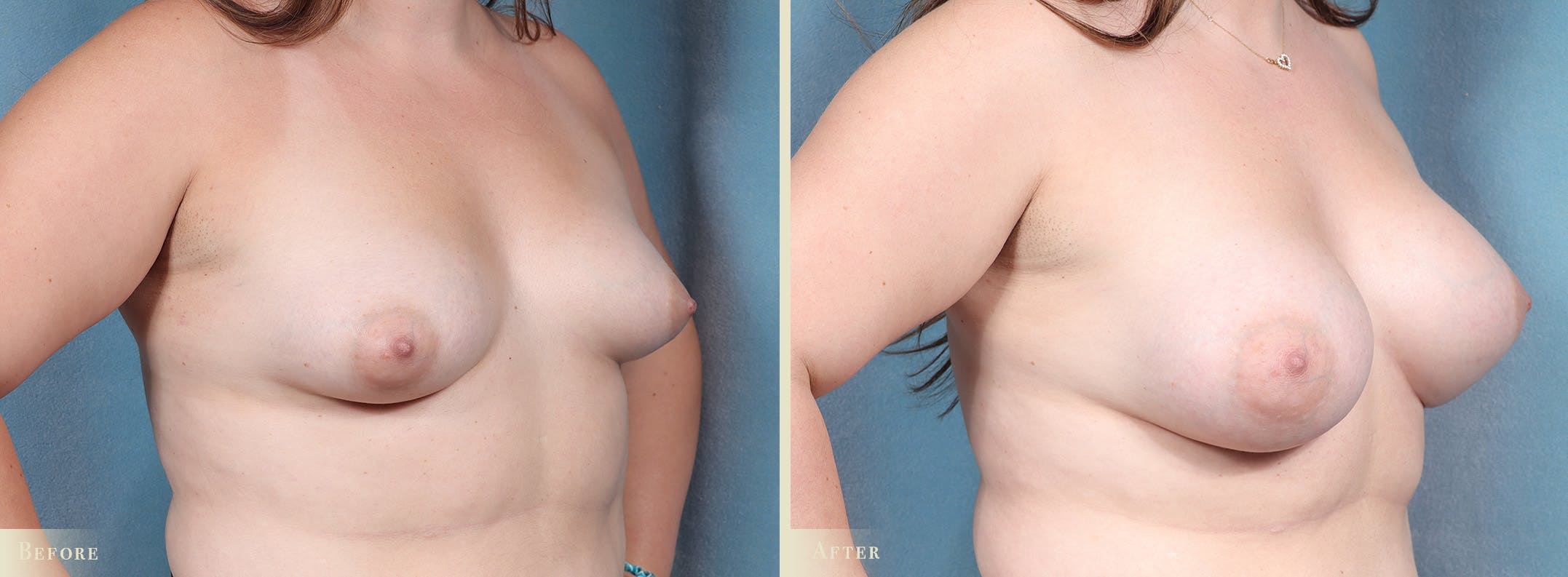 Breast Augmentation Before & After Gallery - Patient 963568 - Image 2