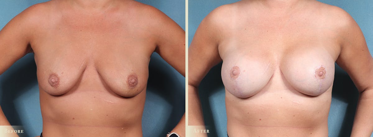 Breast Augmentation Before & After Gallery - Patient 109340 - Image 1