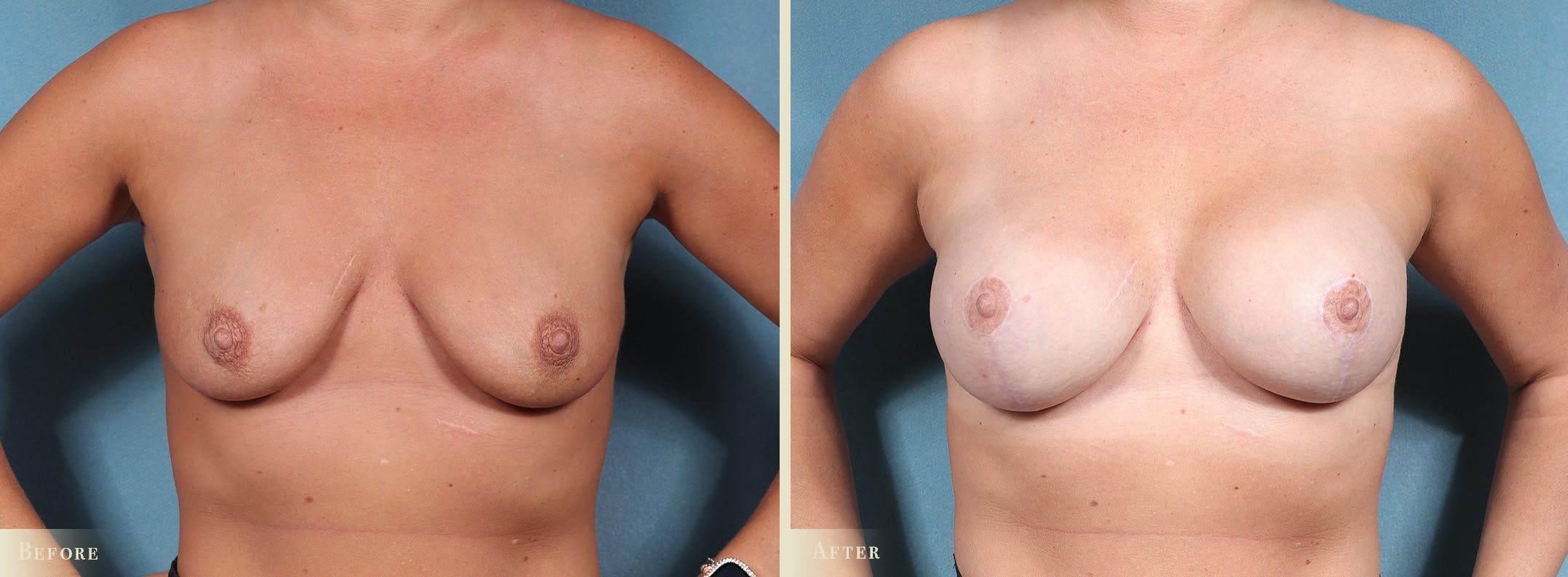 Breast Augmentation Before & After Gallery - Patient 109340 - Image 1