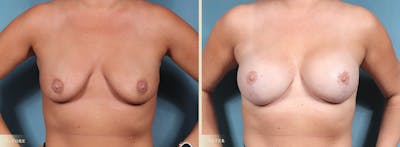 Breast Augmentation Before & After Gallery - Patient 109340 - Image 1
