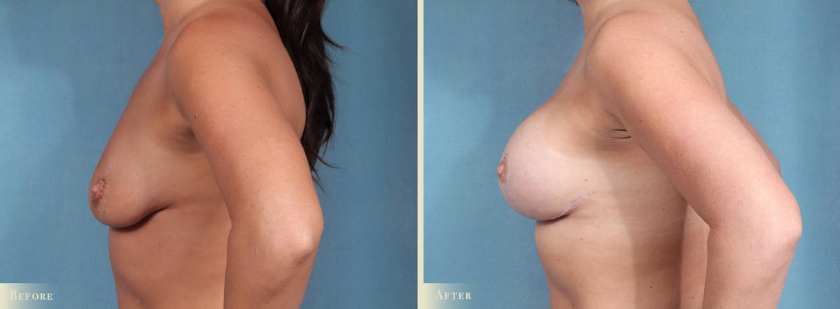 Breast Augmentation Before & After Gallery - Patient 109340 - Image 3