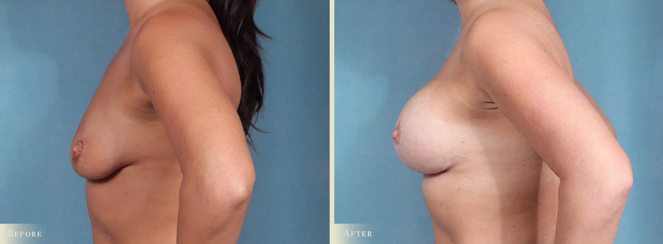 Breast Augmentation Before & After Gallery - Patient 109340 - Image 3