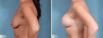Breast Augmentation Before & After Gallery - Patient 109340 - Image 3