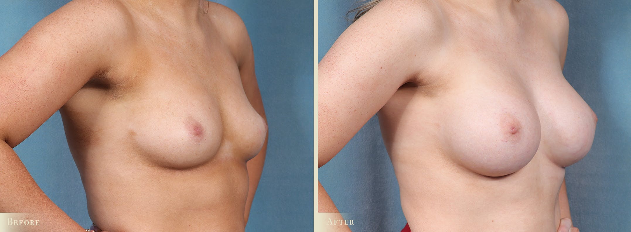 Breast Augmentation Before & After Gallery - Patient 228726 - Image 2