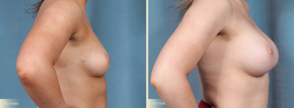 Breast Augmentation Before & After Gallery - Patient 228726 - Image 3