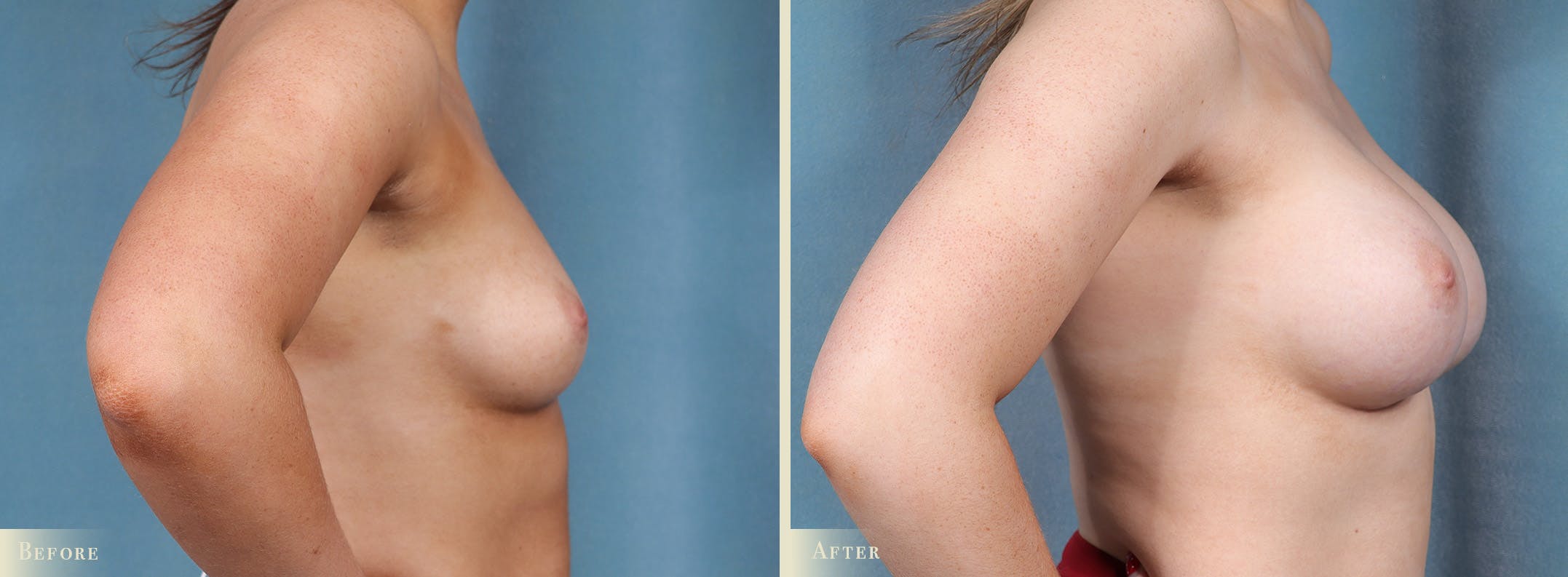 Breast Augmentation Before & After Gallery - Patient 228726 - Image 3