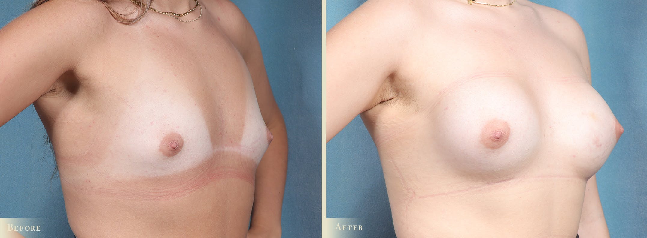 Breast Augmentation Before & After Gallery - Patient 325064 - Image 2