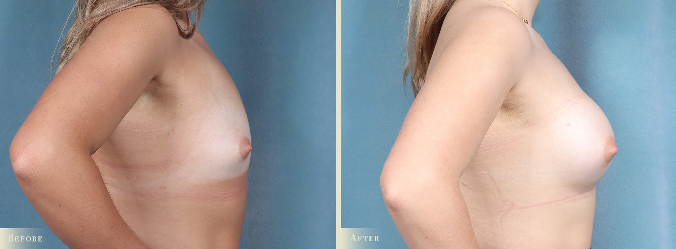 Breast Augmentation Before & After Gallery - Patient 325064 - Image 3