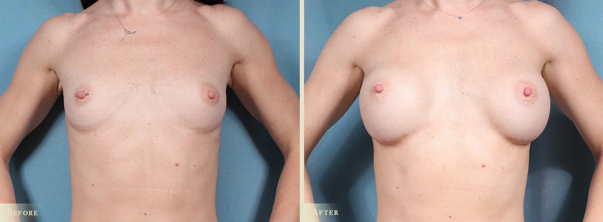 Breast Augmentation Before & After Gallery - Patient 256411 - Image 1