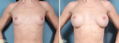 Breast Augmentation Before & After Gallery - Patient 256411 - Image 1