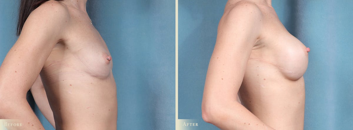 Breast Augmentation Before & After Gallery - Patient 256411 - Image 3