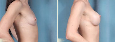 Breast Augmentation Before & After Gallery - Patient 256411 - Image 3
