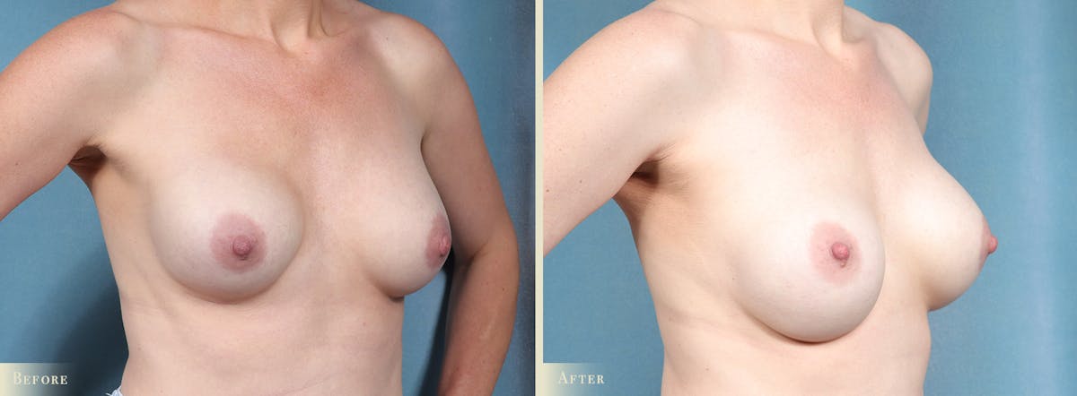 Breast Implant Revision/Replacement Before & After Gallery - Patient 132053 - Image 2