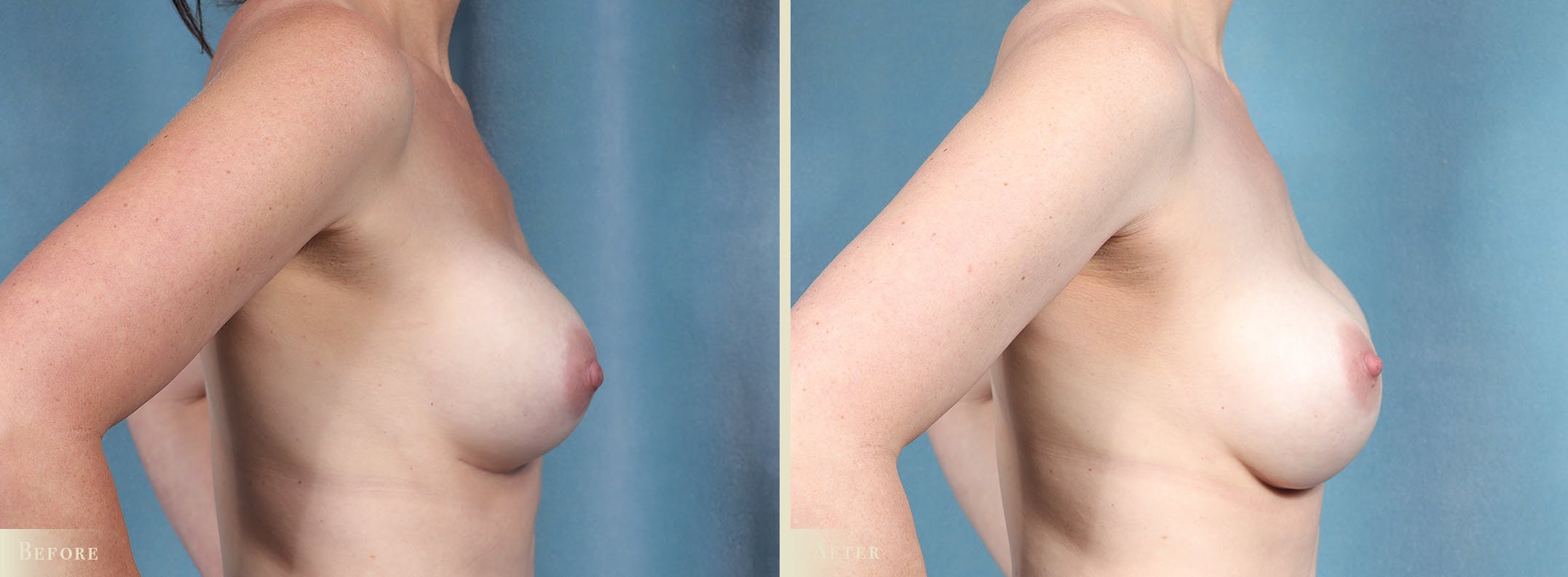 Breast Implant Revision/Replacement Before & After Gallery - Patient 132053 - Image 3