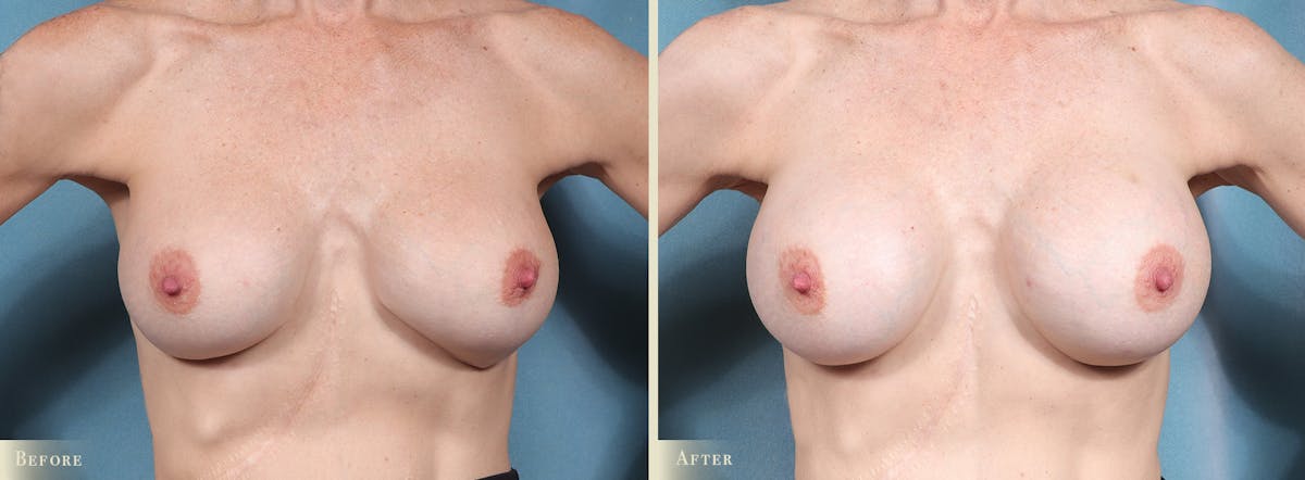 Breast Implant Revision/Replacement Before & After Gallery - Patient 247517 - Image 1