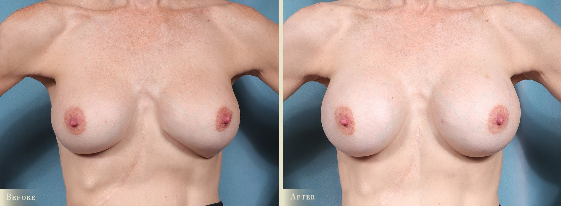 Breast Implant Revision/Replacement Before & After Gallery - Patient 247517 - Image 1