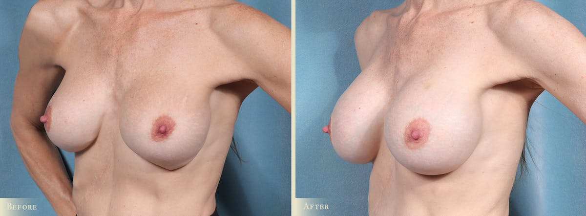 Breast Implant Revision/Replacement Before & After Gallery - Patient 247517 - Image 2
