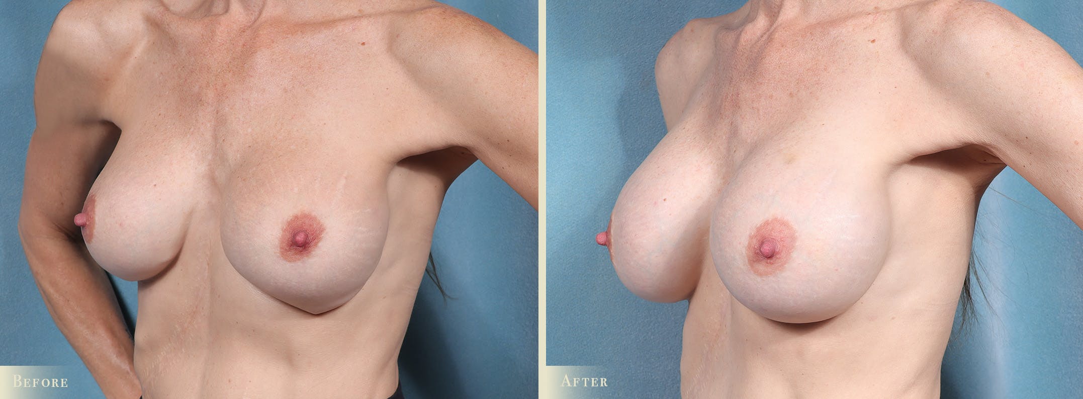 Breast Implant Revision/Replacement Before & After Gallery - Patient 247517 - Image 2