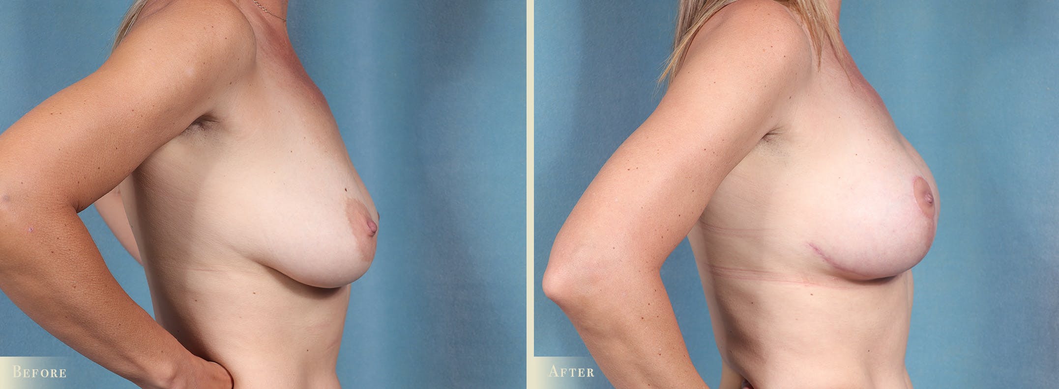 Breast Augmentation and Lift Before & After Gallery - Patient 605772 - Image 3