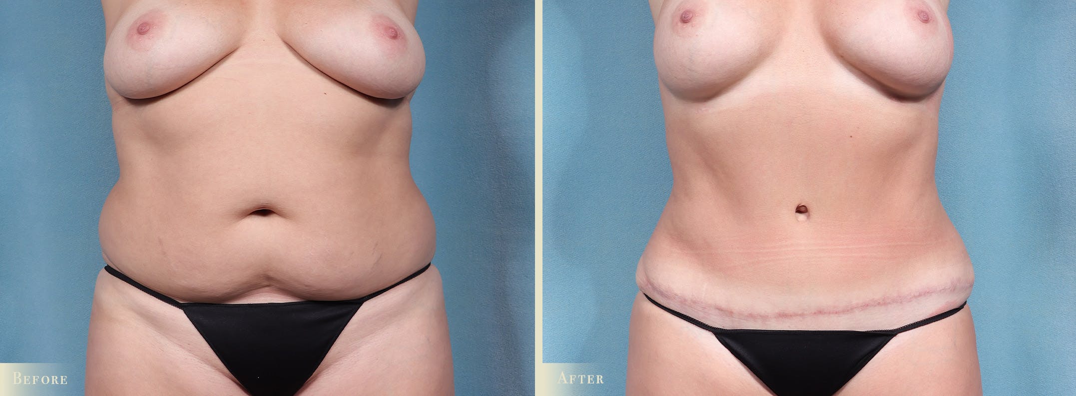 Tummy Tuck Before & After Gallery - Patient 259720 - Image 1