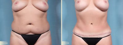 Tummy Tuck Before & After Gallery - Patient 259720 - Image 1