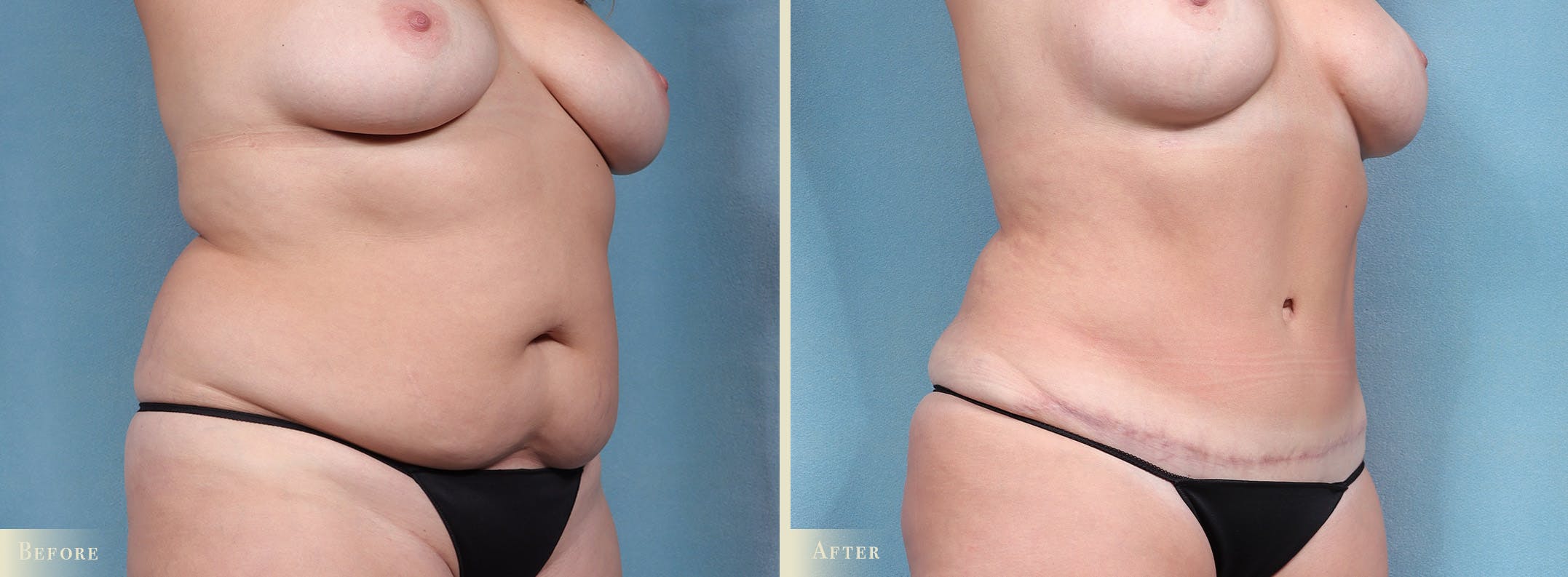Tummy Tuck Before & After Gallery - Patient 259720 - Image 2