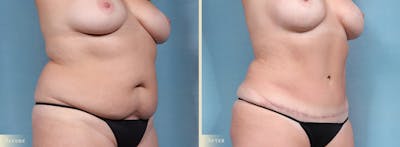Tummy Tuck Before & After Gallery - Patient 259720 - Image 2