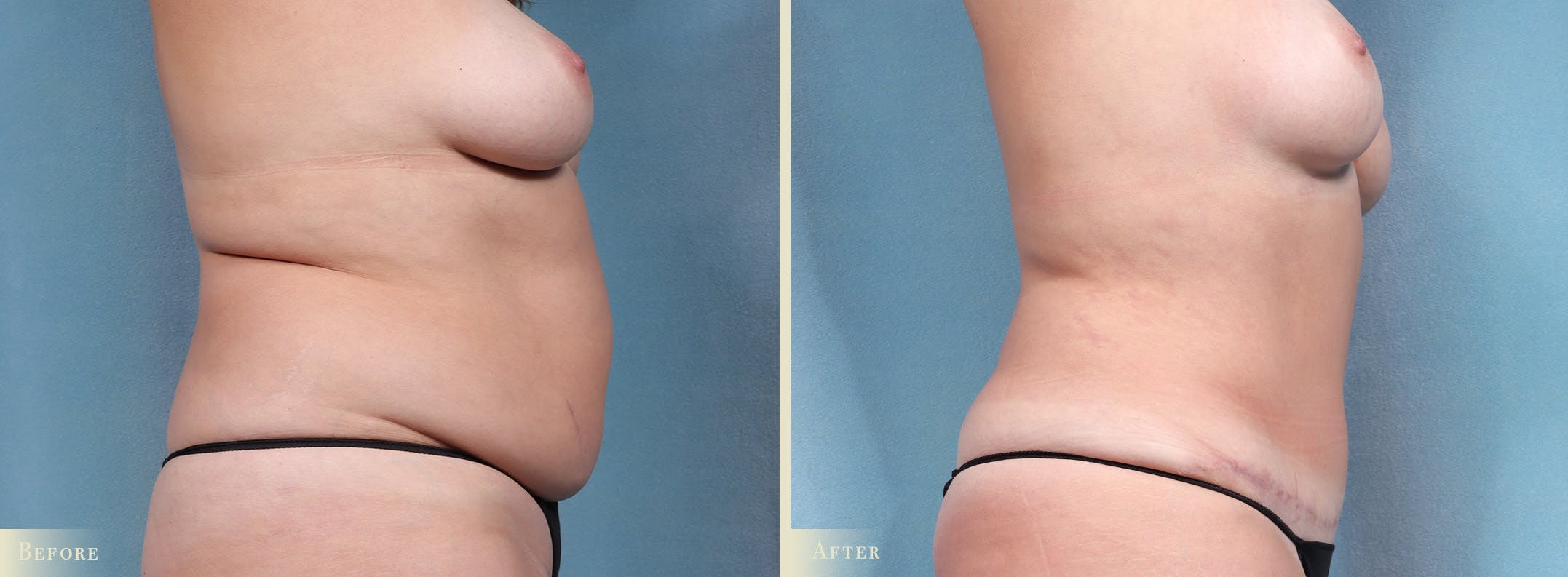 Tummy Tuck Before & After Gallery - Patient 259720 - Image 3
