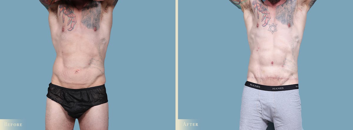 Male Body Lift Before & After Gallery - Patient 269904 - Image 1
