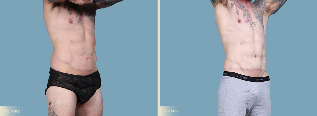 Male Body Lift Before & After Gallery - Patient 269904 - Image 2
