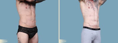 Male Body Lift Before & After Gallery - Patient 269904 - Image 2