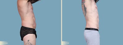 Male Body Lift Before & After Gallery - Patient 269904 - Image 3
