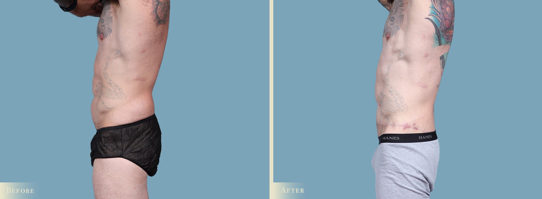 Male Body Lift Before & After Gallery - Patient 269904 - Image 4