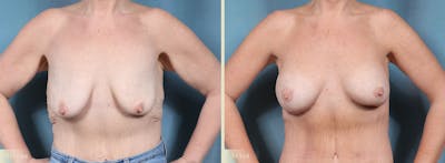 Weight Loss Body Contouring Combination Procedures Before & After Gallery - Patient 128843 - Image 1