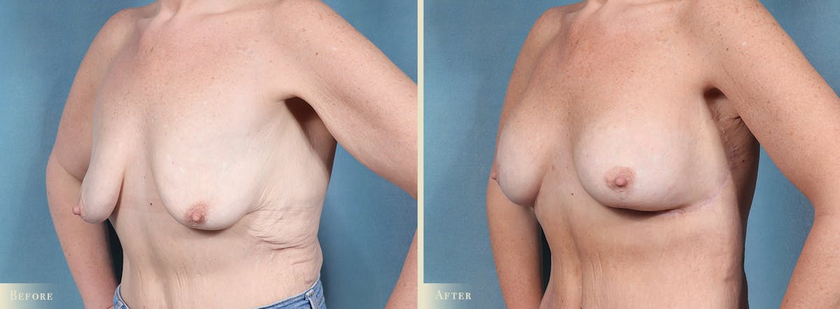 Weight Loss Body Contouring Combination Procedures Before & After Gallery - Patient 128843 - Image 2