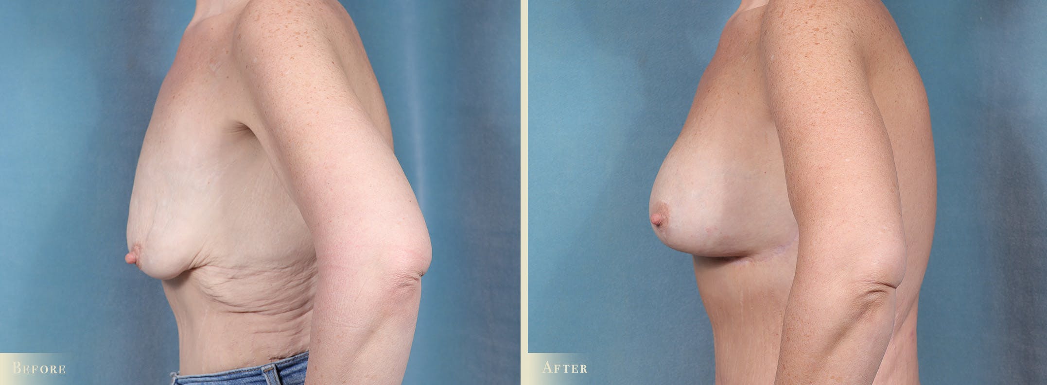 Weight Loss Body Contouring Combination Procedures Before & After Gallery - Patient 128843 - Image 3