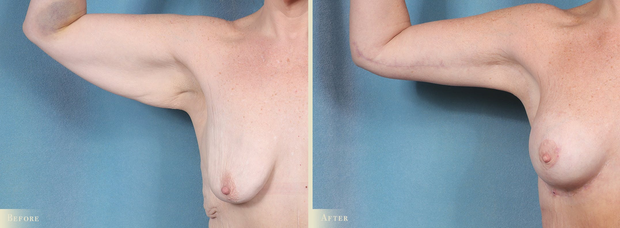 Weight Loss Body Contouring Combination Procedures Before & After Gallery - Patient 128843 - Image 4