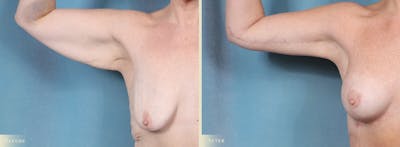 Weight Loss Body Contouring Combination Procedures Before & After Gallery - Patient 128843 - Image 4