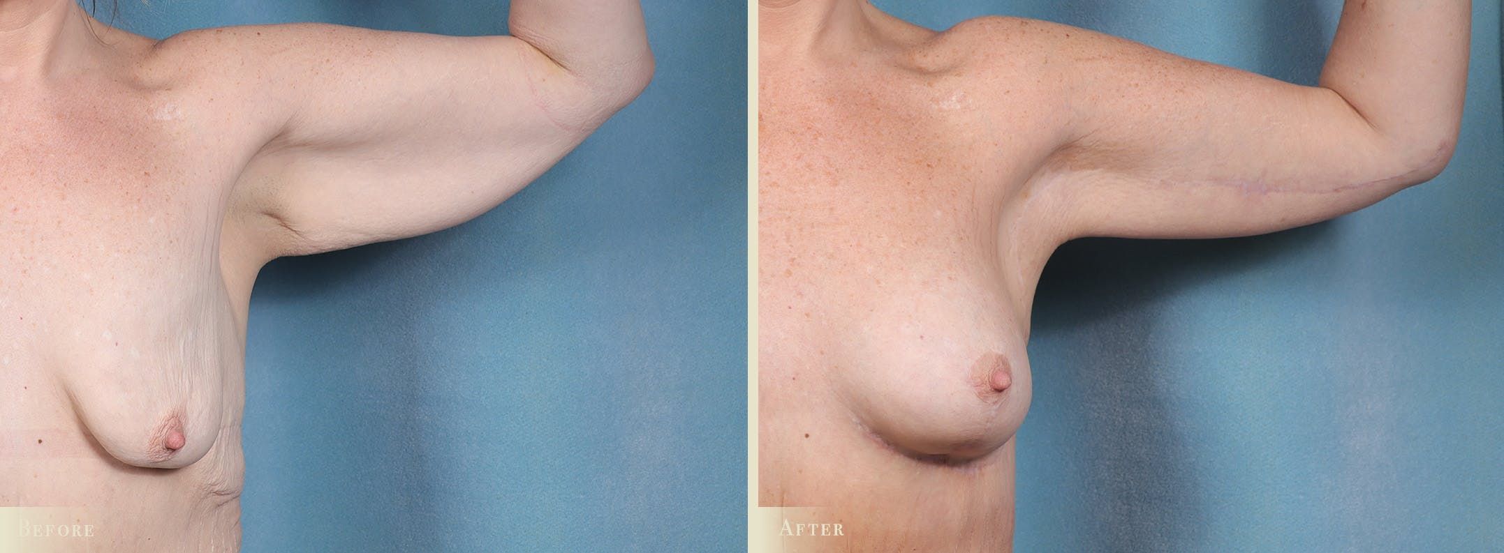 Weight Loss Body Contouring Combination Procedures Before & After Gallery - Patient 128843 - Image 5