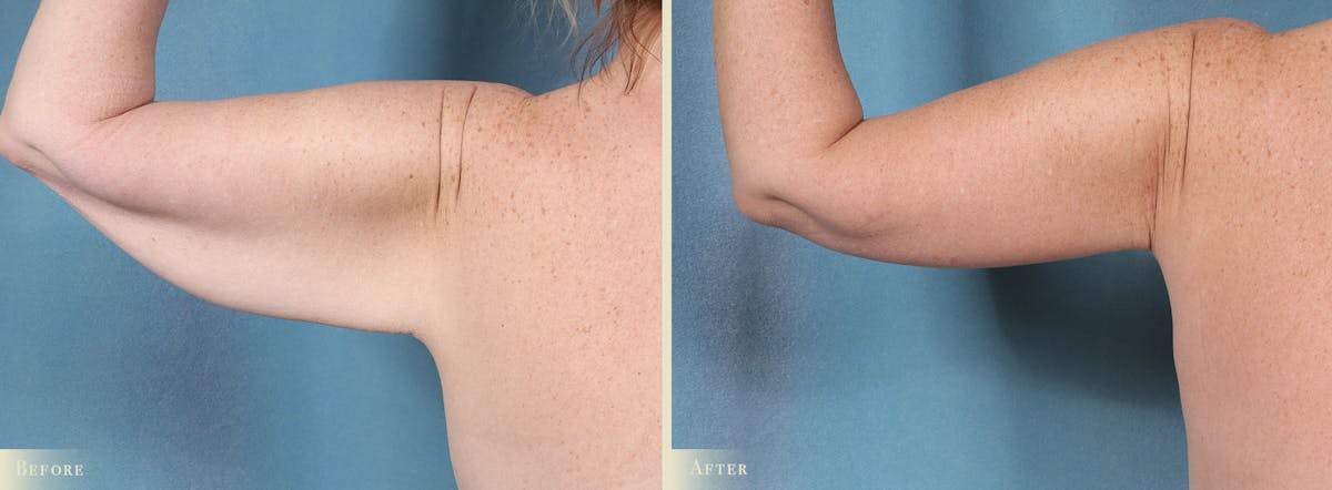 Weight Loss Body Contouring Combination Procedures Before & After Gallery - Patient 128843 - Image 7