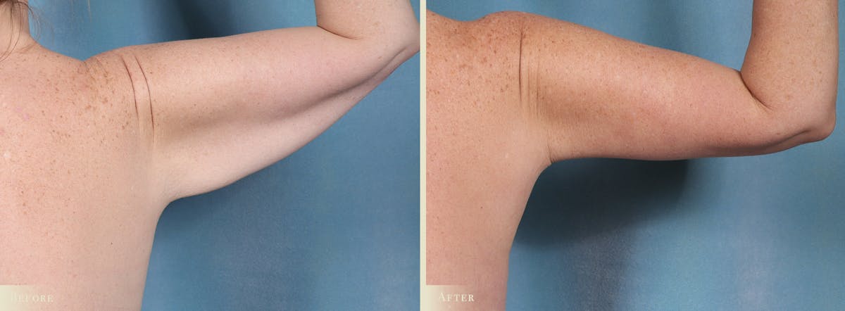 Weight Loss Body Contouring Combination Procedures Before & After Gallery - Patient 128843 - Image 6