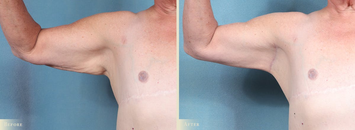 Arm Lift Before & After Gallery - Patient 307255 - Image 2