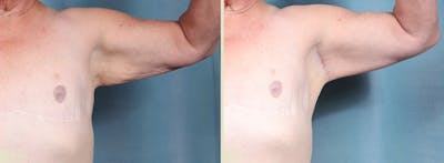 Arm Lift Before & After Gallery - Patient 307255 - Image 1