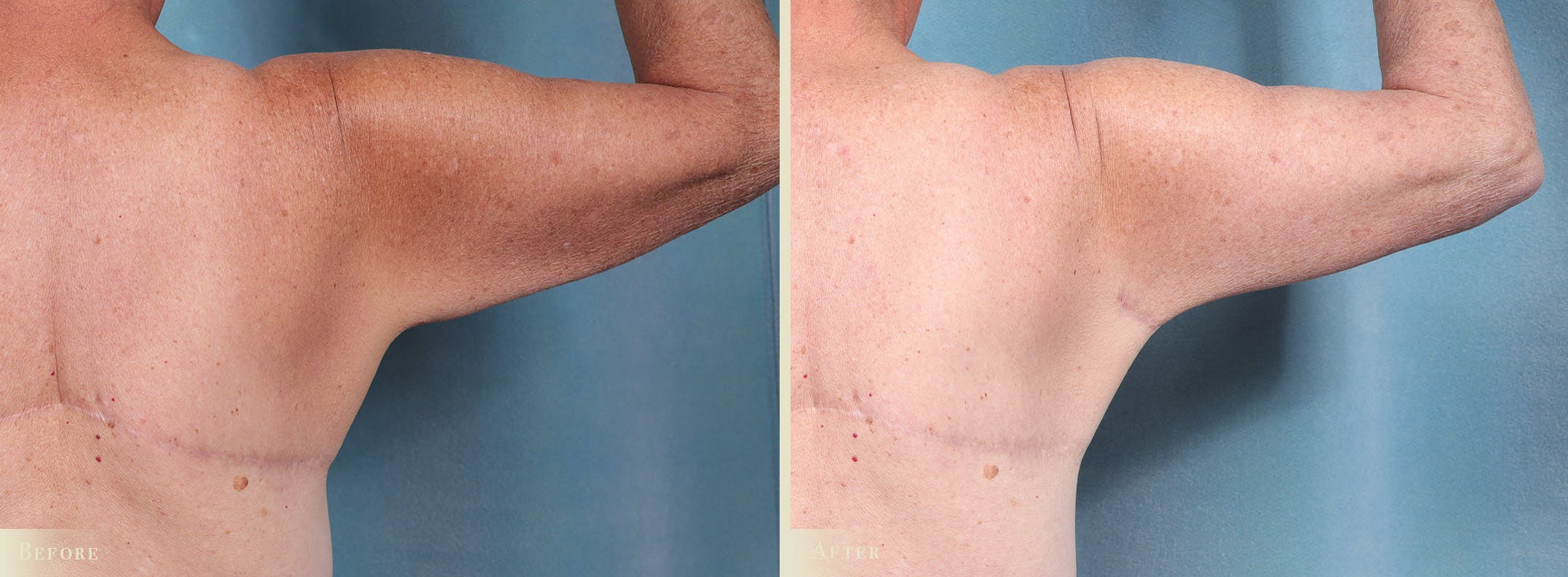 Arm Lift Before & After Gallery - Patient 307255 - Image 3