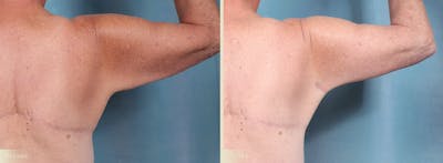 Arm Lift Before & After Gallery - Patient 307255 - Image 3