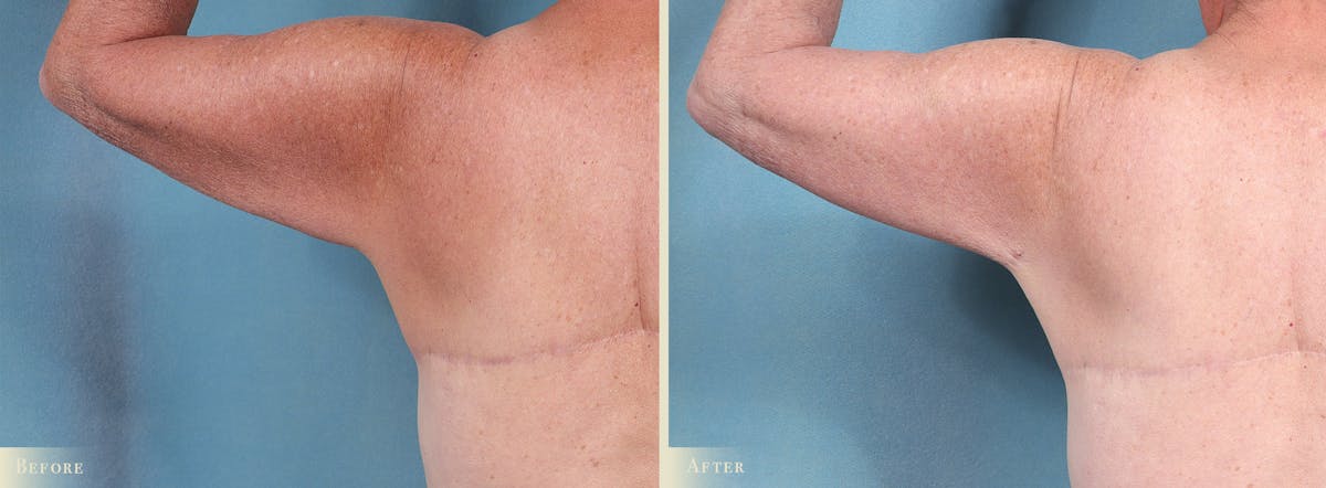 Arm Lift Before & After Gallery - Patient 307255 - Image 4