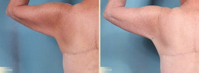 Arm Lift Before & After Gallery - Patient 307255 - Image 4