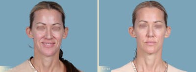 Eyelid Lift Before & After Gallery - Patient 285992 - Image 1